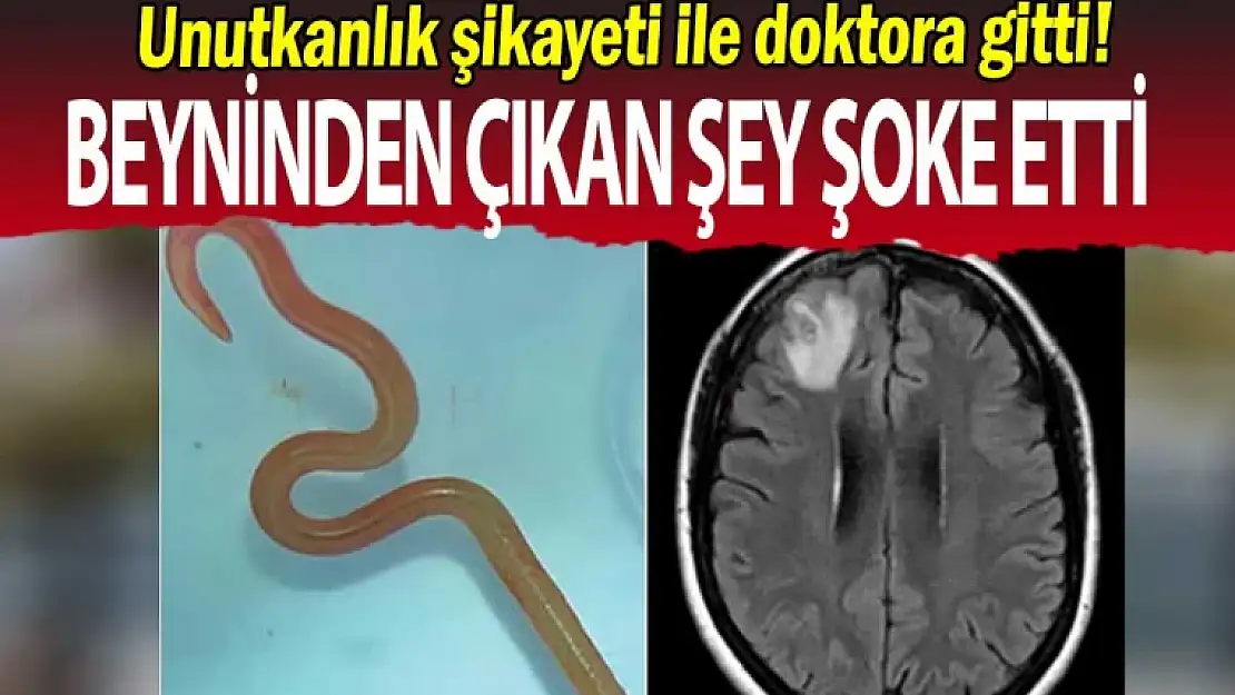 Unutkanlık şikayeti ile doktora gitti: Beyninden çıkan şey şoke etti