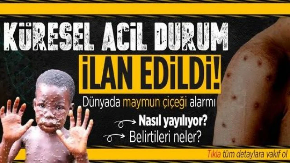 DSÖ'den maymun çiçeği için küresel acil durum ilanı