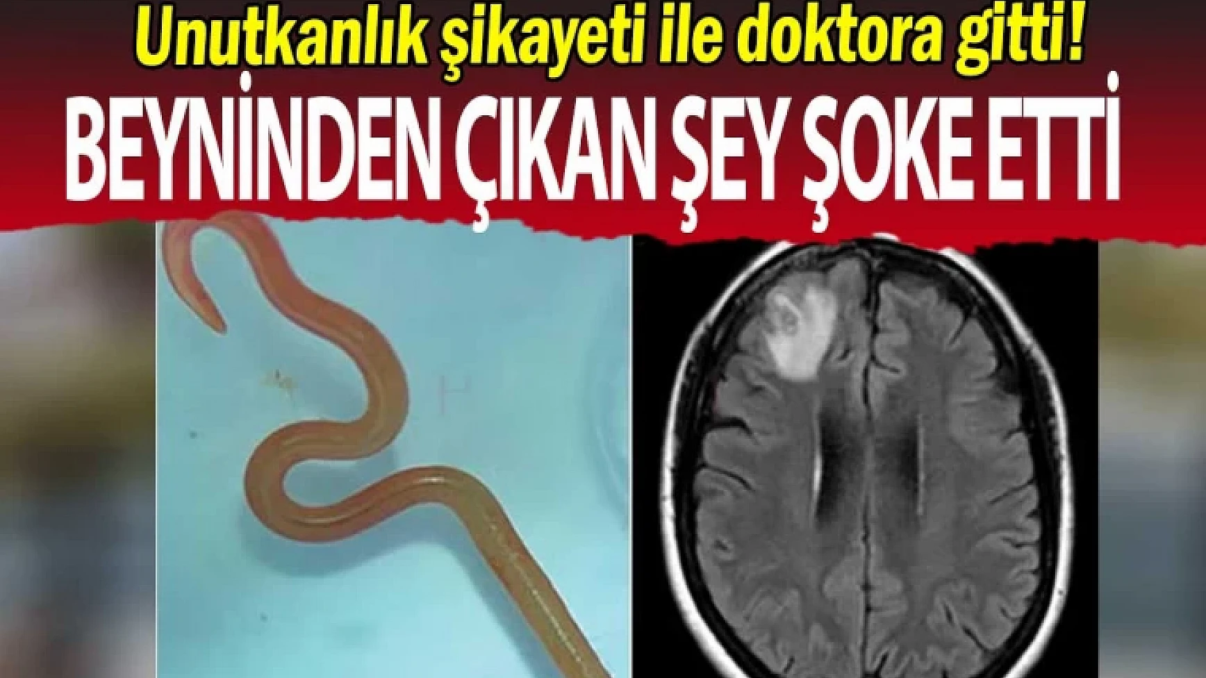 Unutkanlık şikayeti ile doktora gitti: Beyninden çıkan şey şoke etti